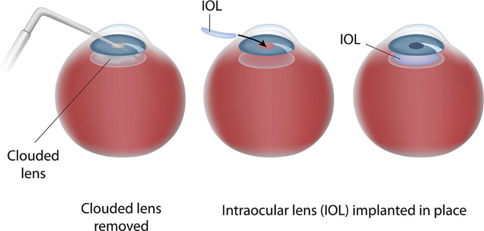 Clouded Lens, Clouded Lens Removed, Intraocular Lens (IOL) implanted in place.